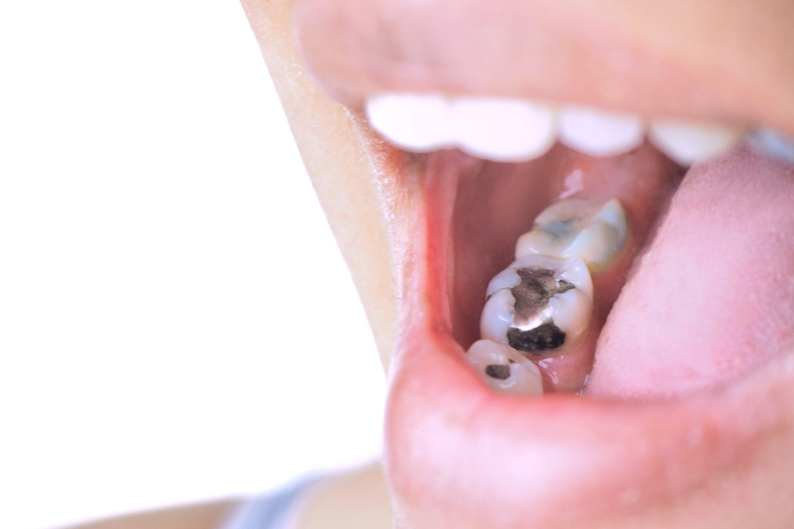 Zahnarzt Wiesloch verrät: Welche Zahnfüllung ist die beste?